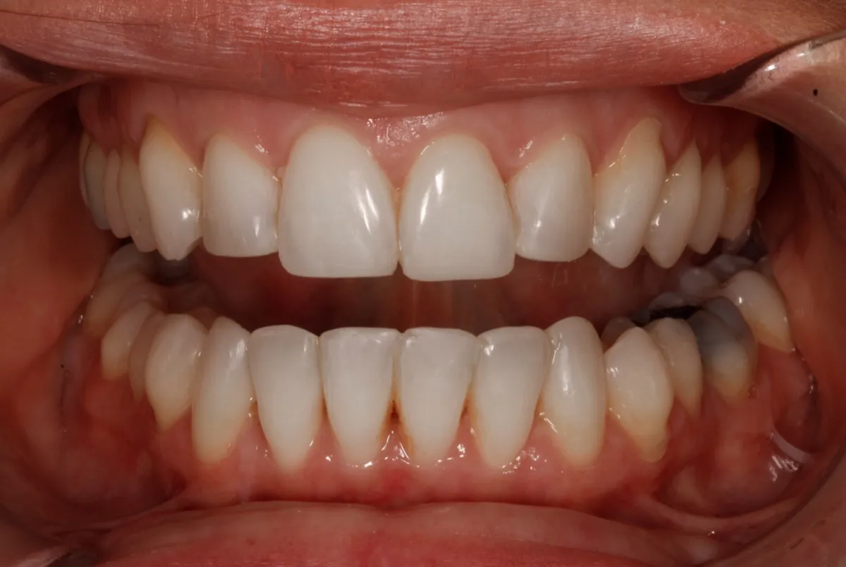 Caso de alinhador invisível: arcadas superior e inferior em vista frontal, com afastador labial