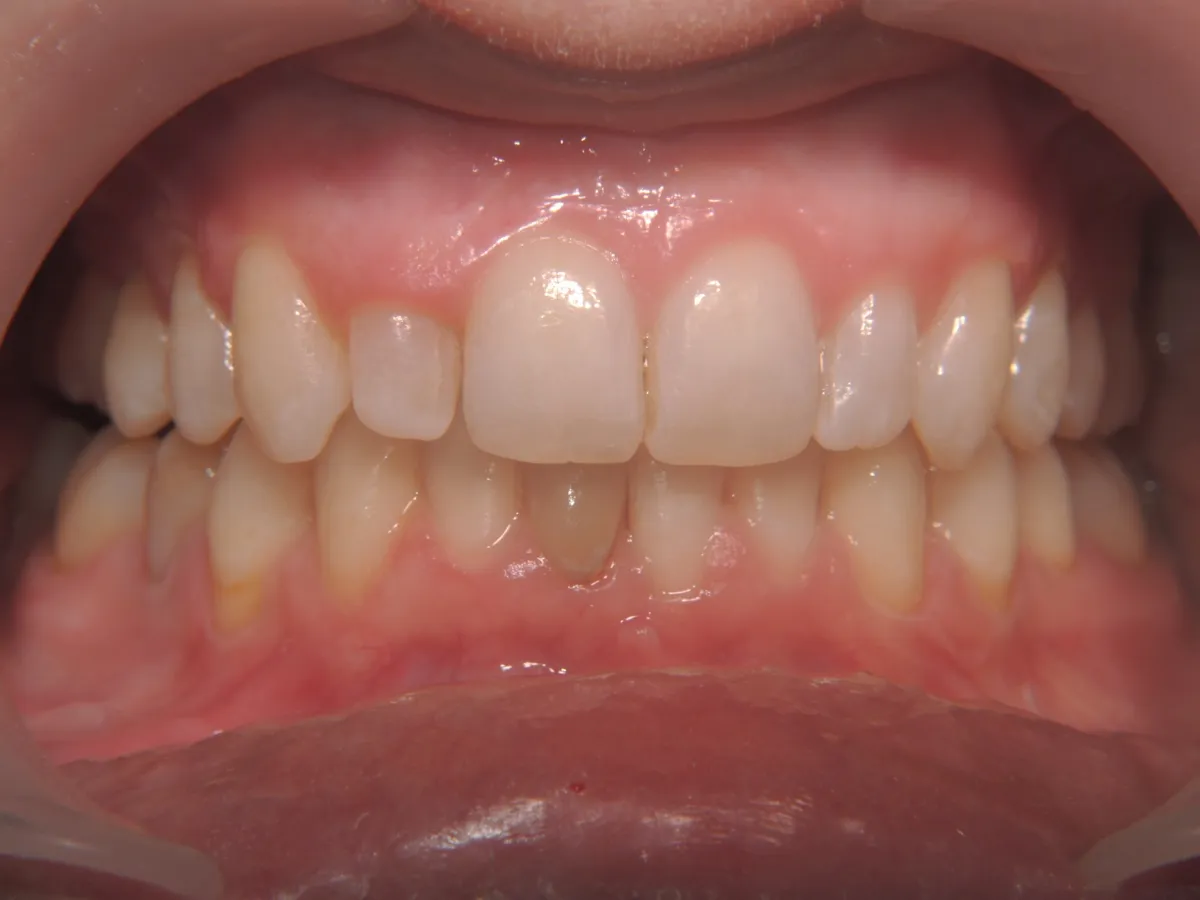 Caso de alinhador invisível: dentes anteriores em vista frontal