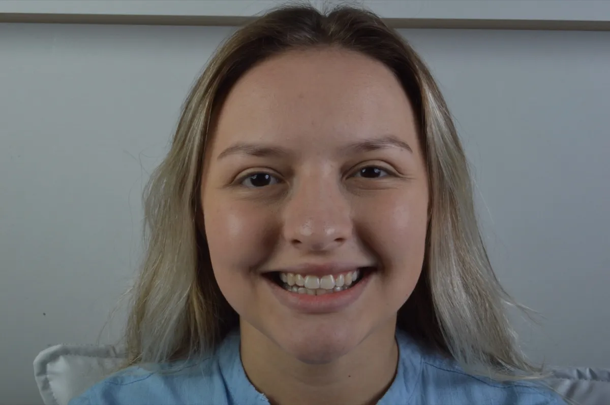 Paciente sorrindo durante o tratamento com alinhador